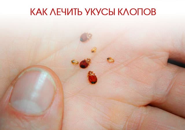 Как лечиться после укусов постельных клопов?